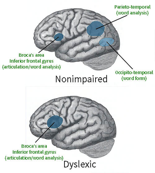 dyslexia in children